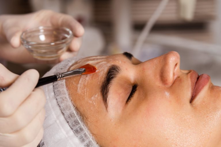Chemical Peels in Algonquin at Fox River MedSpa in Algonquin, Illinois